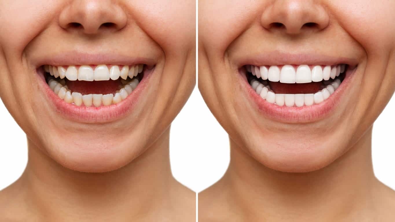 Teeth Whitening Gold Coast Mobile vs In‑Clinic Explained