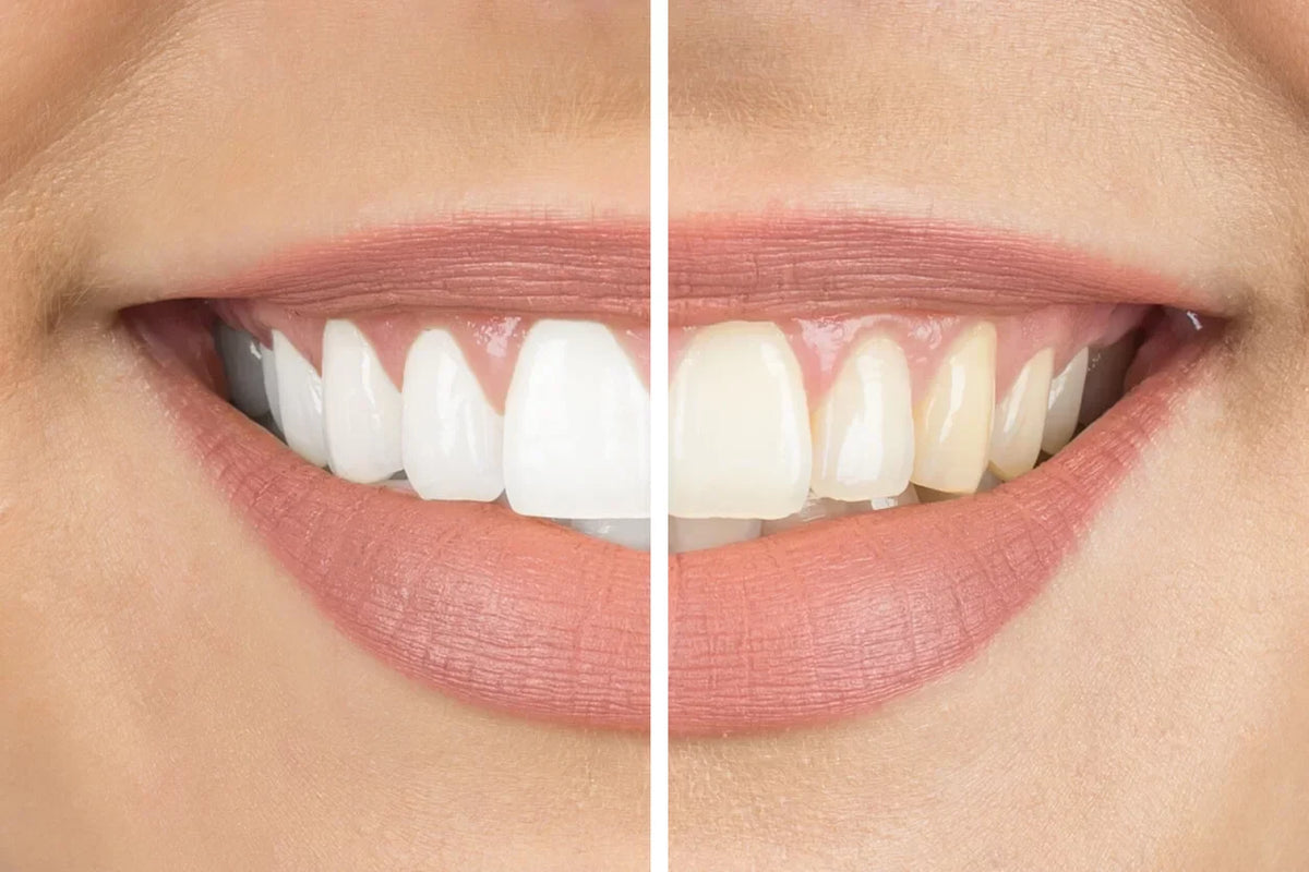 Why SmileFresh Teeth Whitening Products Are Australia’s Favourite Way to Stay Bright