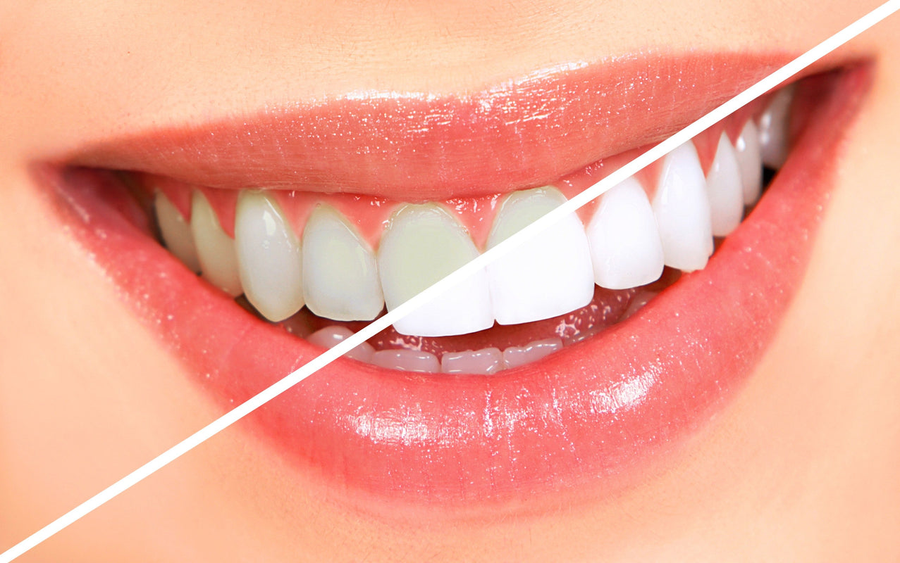 Teeth Whitening Melbourne CBD – How to Choose the Best Option