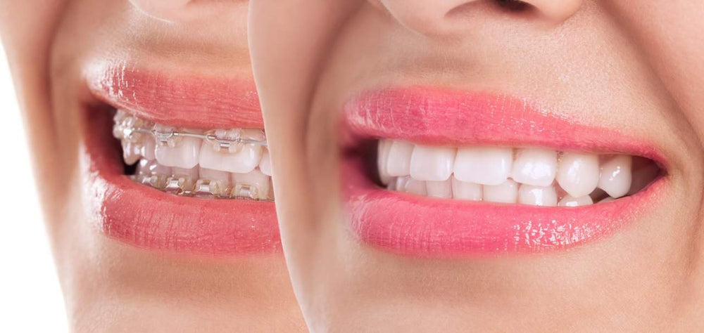 Why Going to a Teeth Whitening Business Is Better Than the Dentist